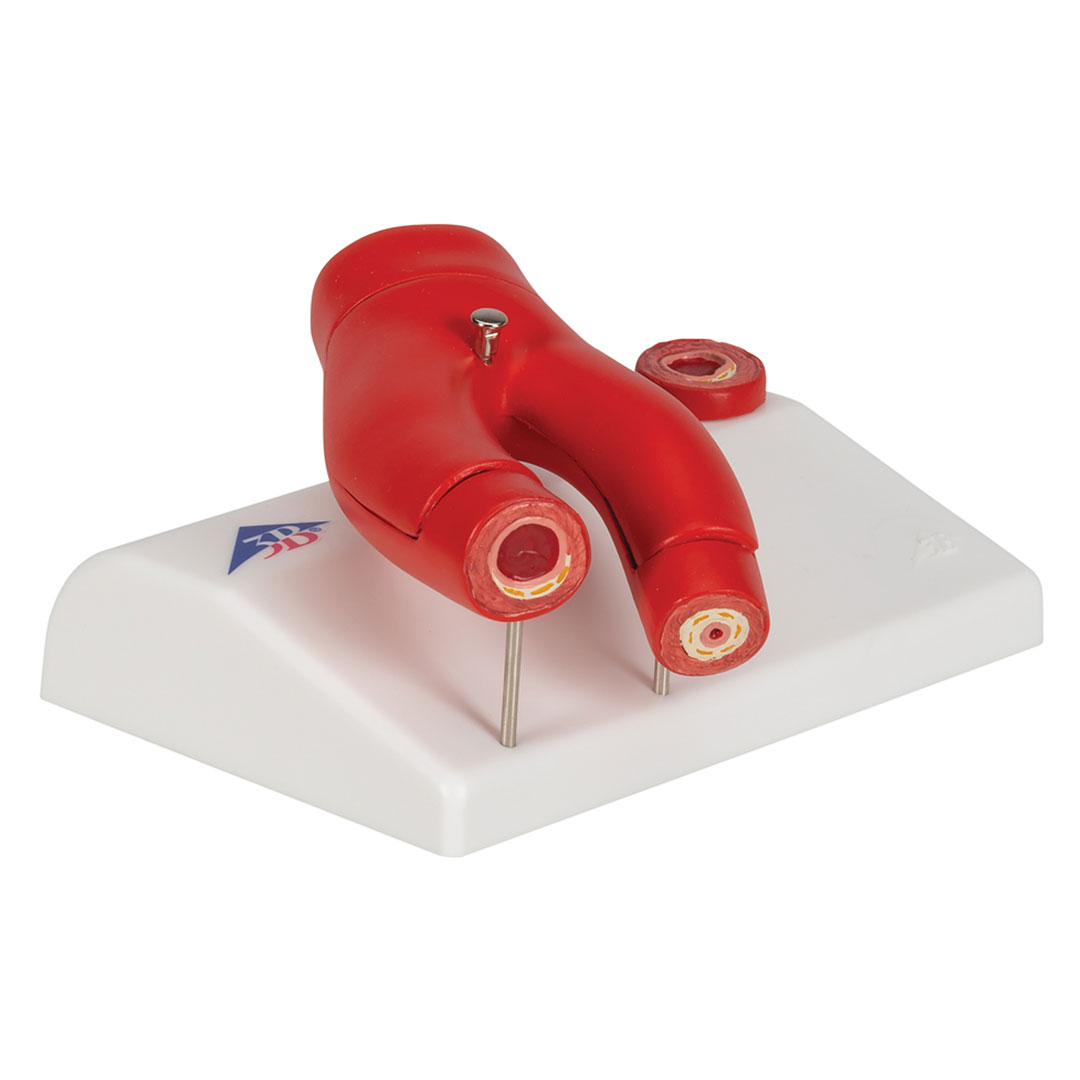 3B SCIENTIFIC Arteriosklerose Modell (G40) mit Querschnitt der Arterie, 2-teilig