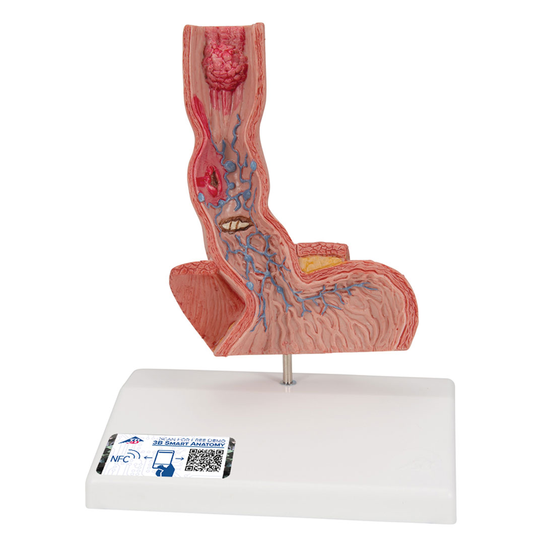 3B SCIENTIFIC Erkrankung der Speiseröhre (K18)
