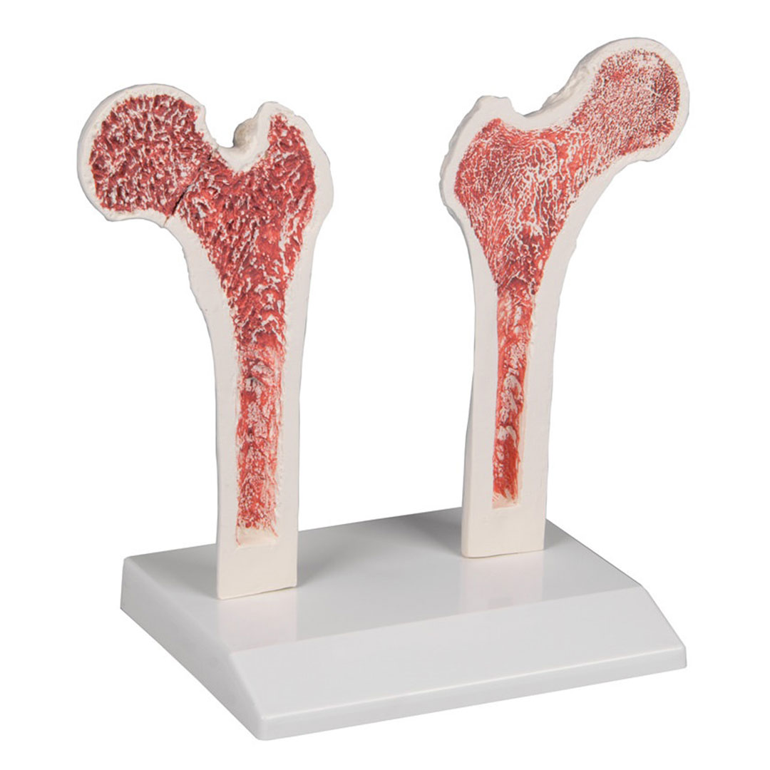 ERLER ZIMMER Osteoporose - Oberschenkel