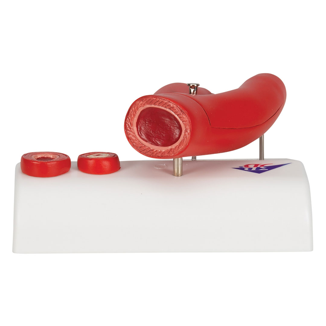 3B SCIENTIFIC Arteriosklerose Modell (G40) mit Querschnitt der Arterie, 2-teilig