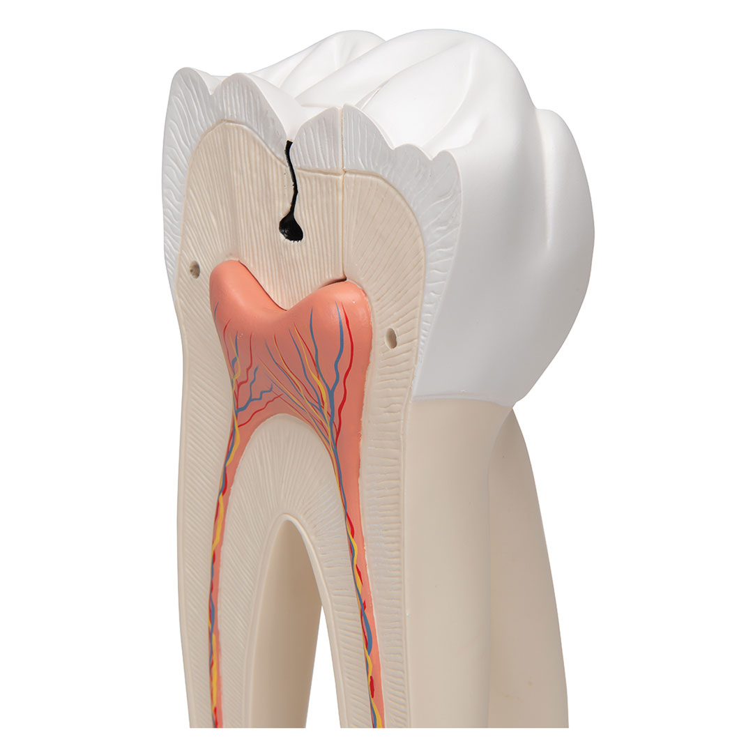 3B SCIENTIFIC Mahlzahn, oben, dreiwurzelig, 5-tlg. (D15)