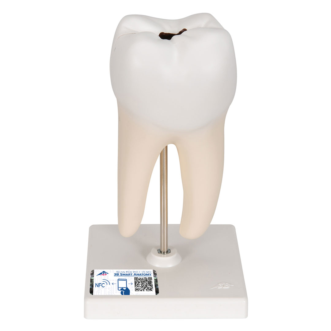 3B SCIENTIFIC Unterer 2-wurzl.Backenzahn m.Karies,2-t. (D10/4)