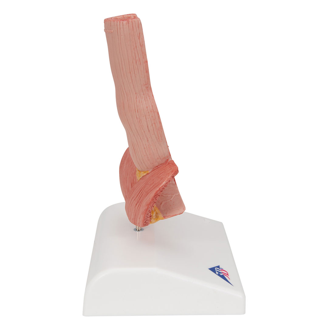 3B SCIENTIFIC Erkrankung der Speiseröhre (K18)