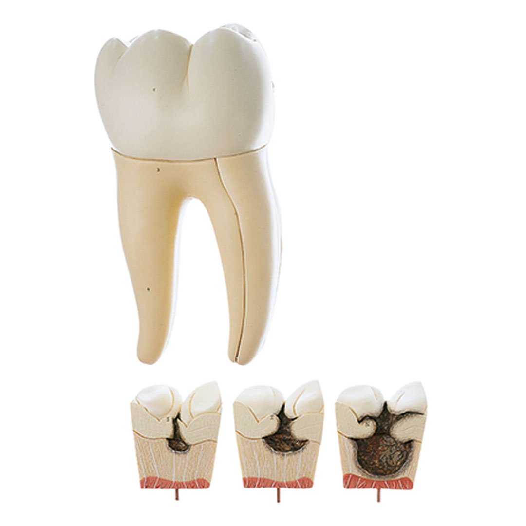 SOMSO® Erster Mahlzahn (unten rechts)*