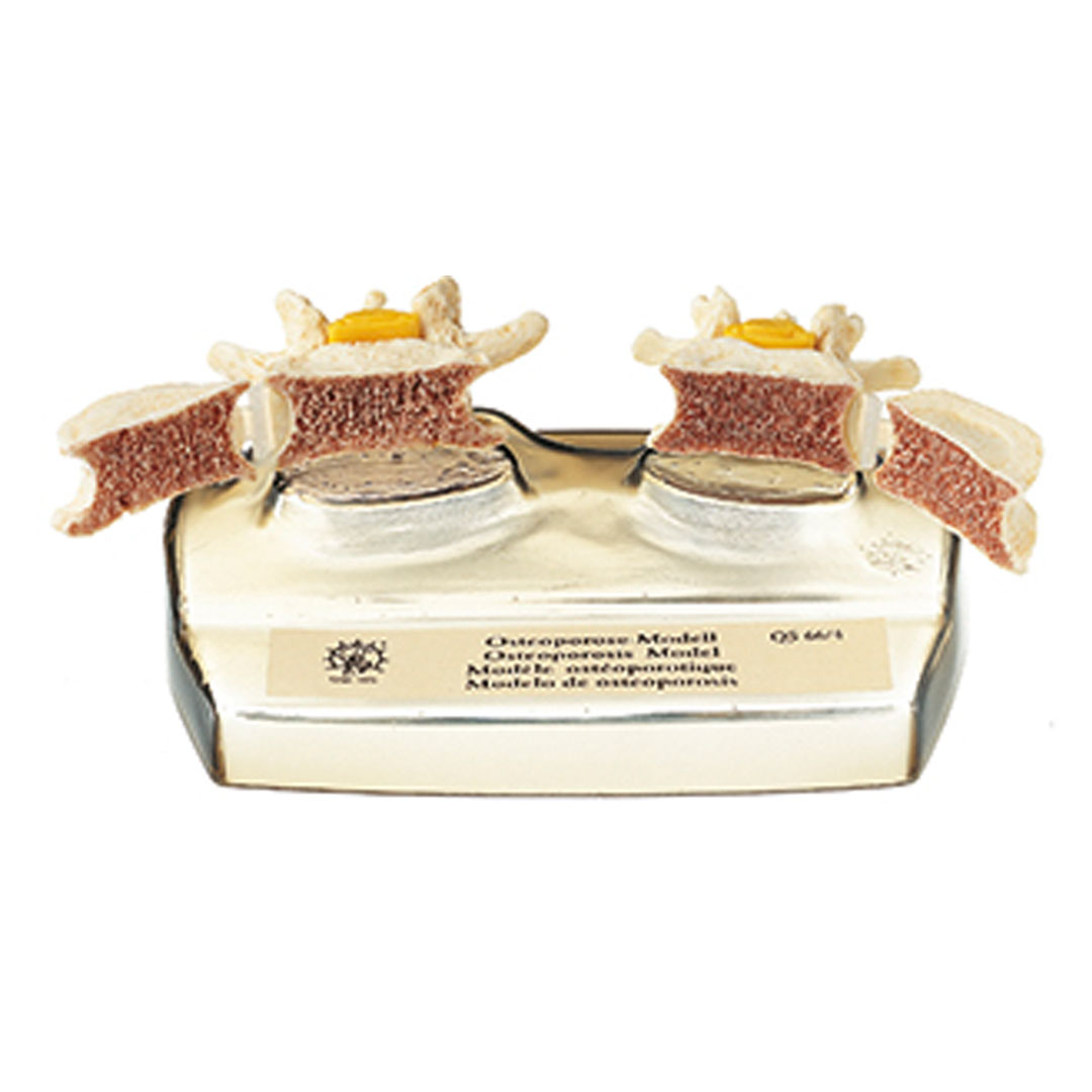 SOMSO® Osteoporose-Modell