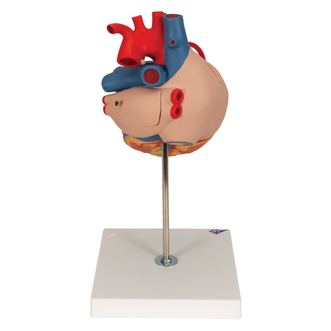 3B SCIENTIFIC Herzmodell m. Bypass, 4-tlg.2-fach v (G06)