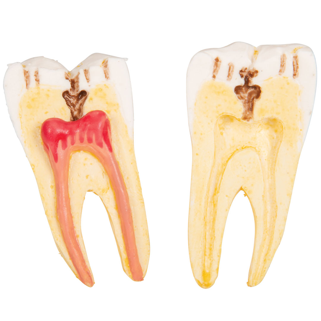 3B SCIENTIFIC Zahnerkrankung Unterkiefermodell 2-fach vergrössert (D26)