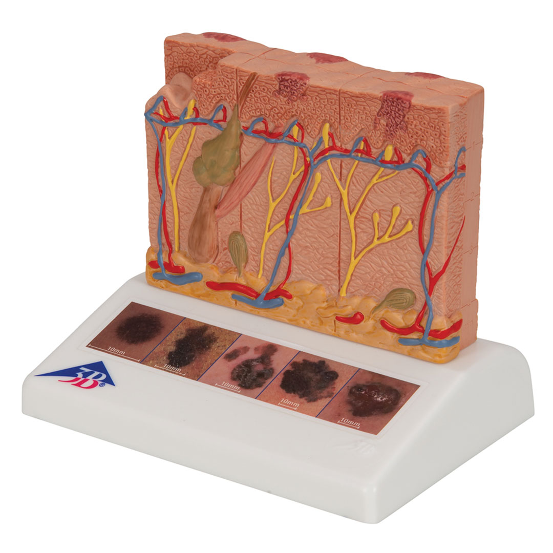 3B SCIENTIFIC Hautkrebs-Modell (J15)