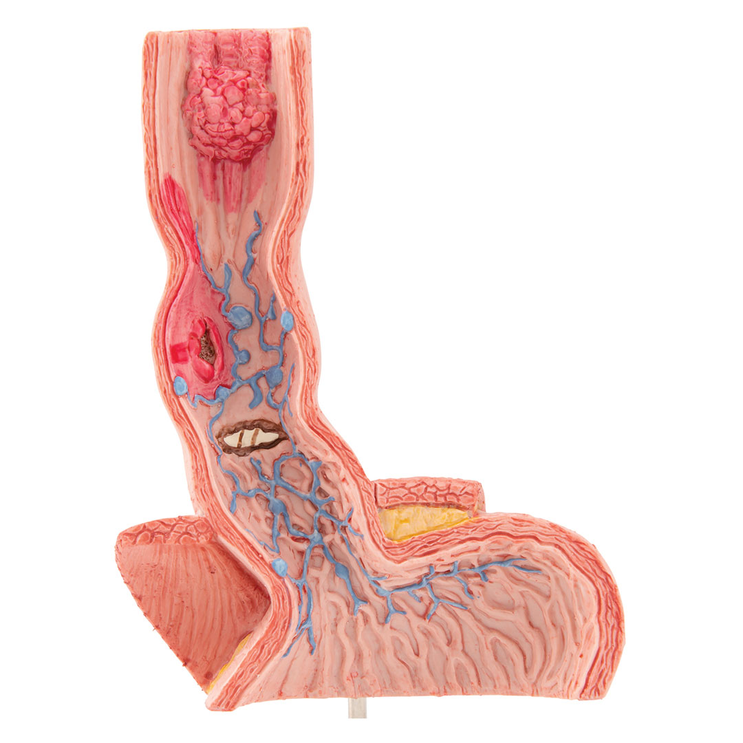 3B SCIENTIFIC Erkrankung der Speiseröhre (K18)