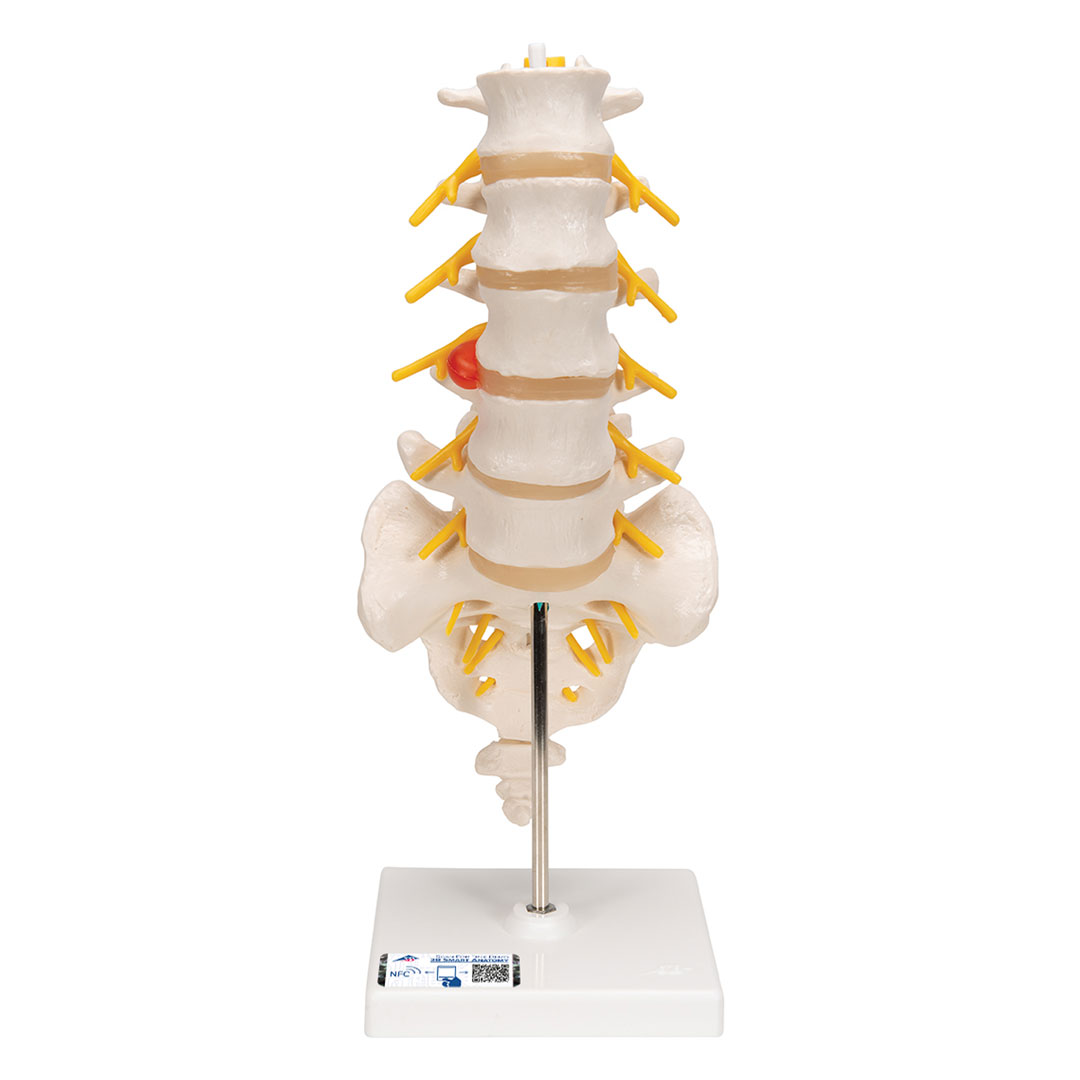 3B SCIENTIFIC Lendenwirbelsäule m. Bandscheibenvorfall (A76/5)
