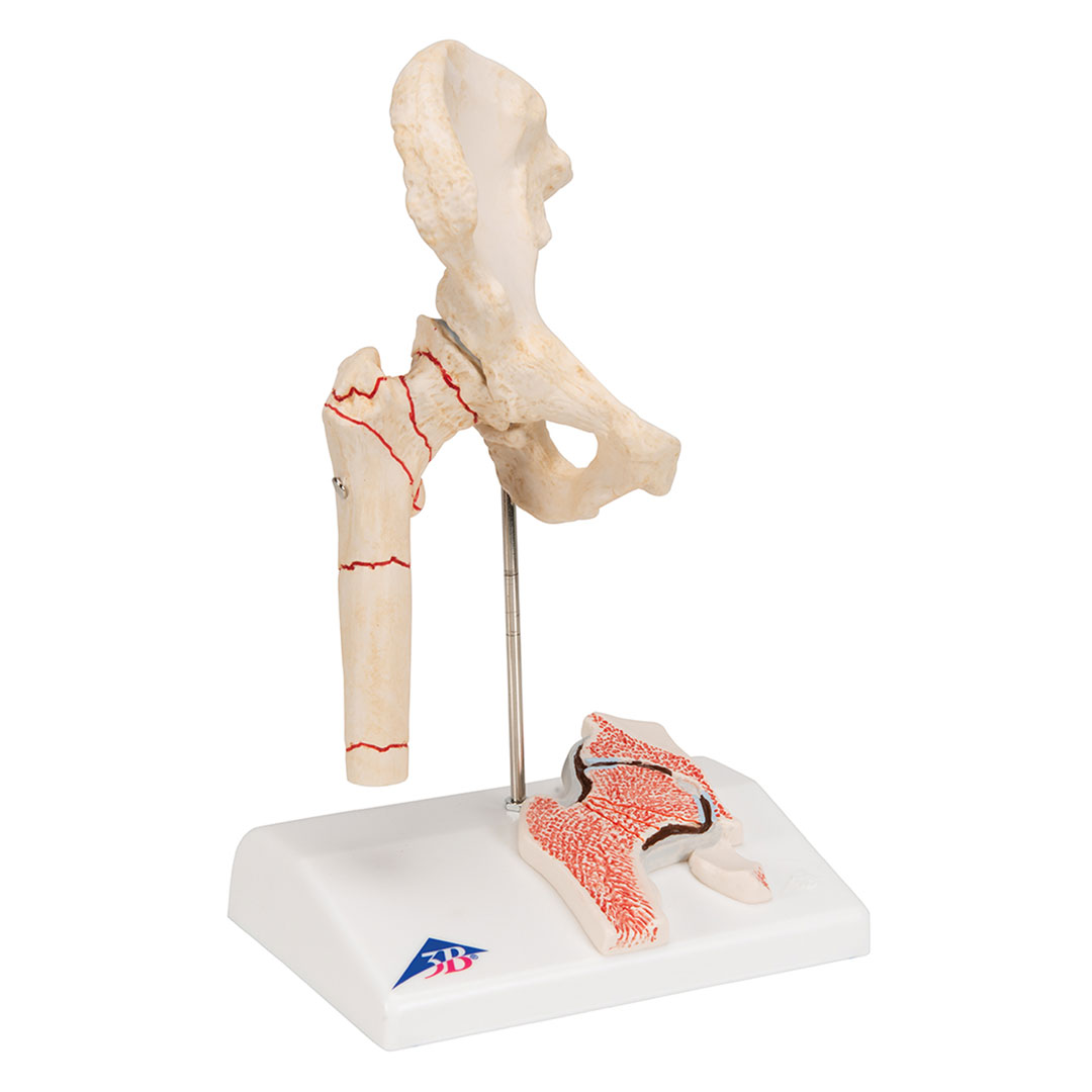 3B SCIENTIFIC Oberschenkelbruch und Hüftgelenkverschleiss (A88)