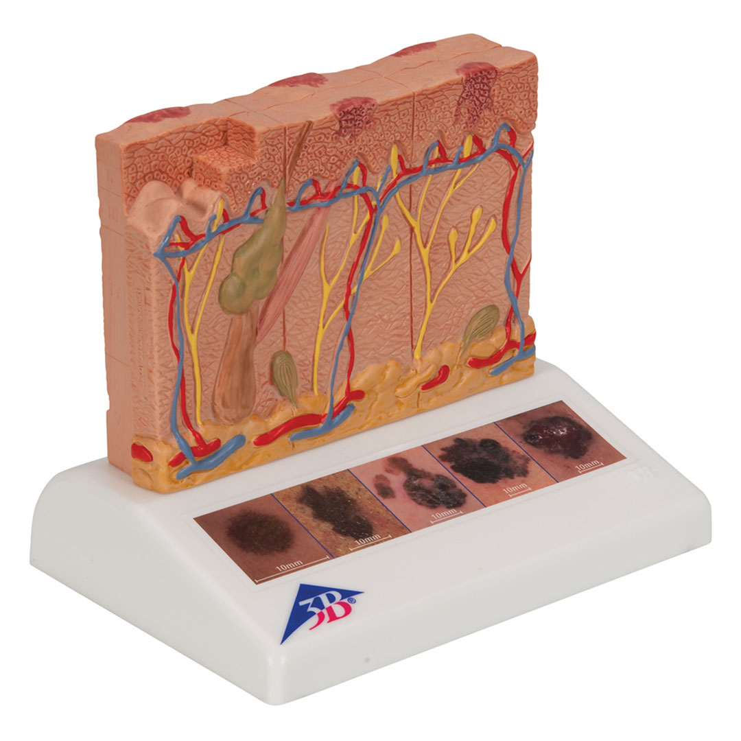 3B SCIENTIFIC Hautkrebs-Modell (J15)