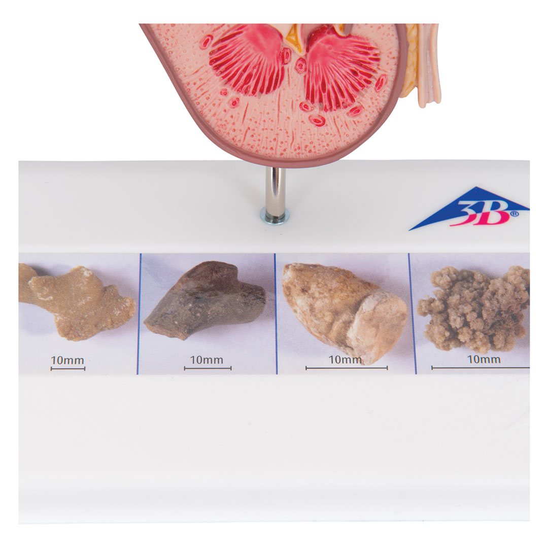 3B SCIENTIFIC Nierensteinmodell (K29)