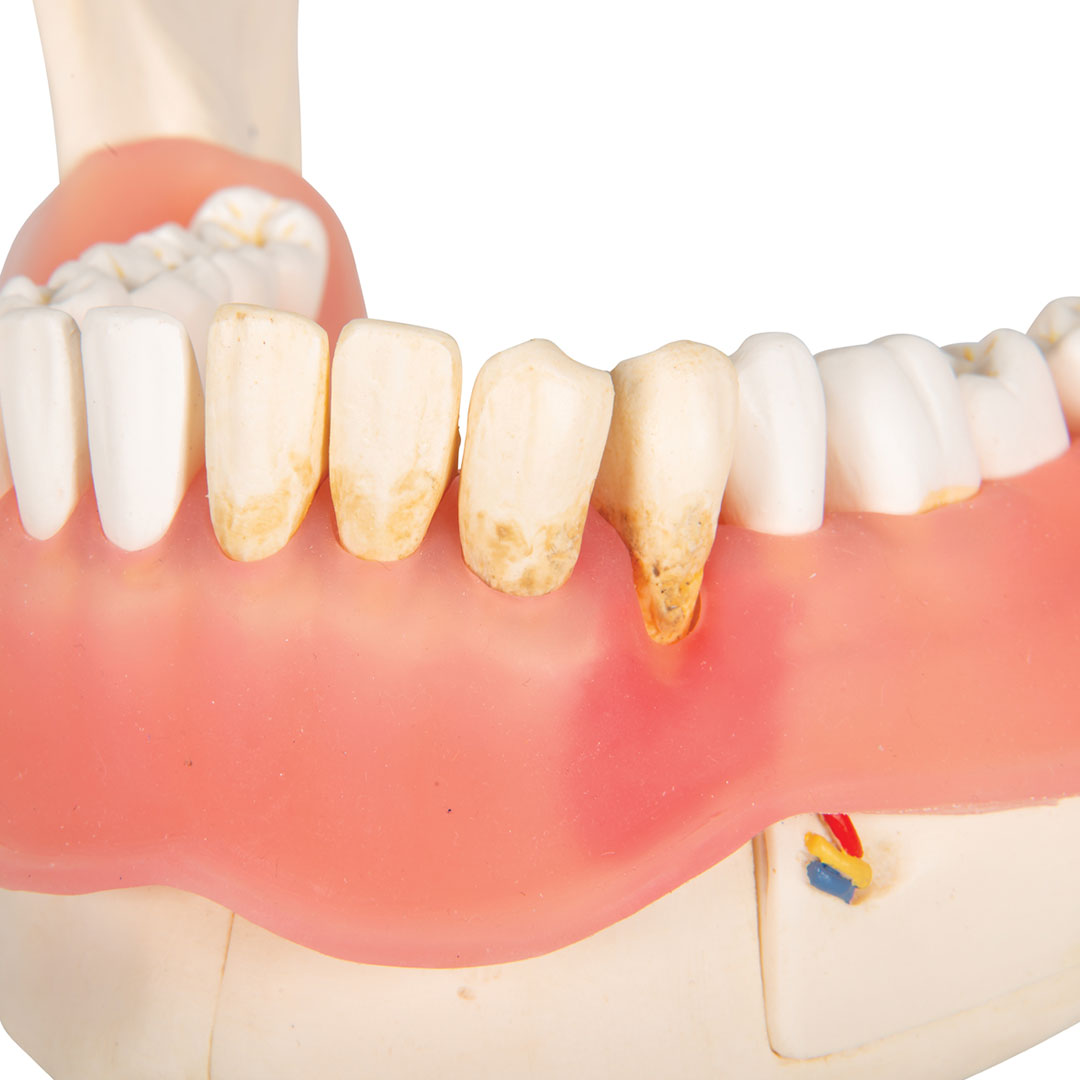 3B SCIENTIFIC Zahnerkrankung Unterkiefermodell 2-fach vergrössert (D26)