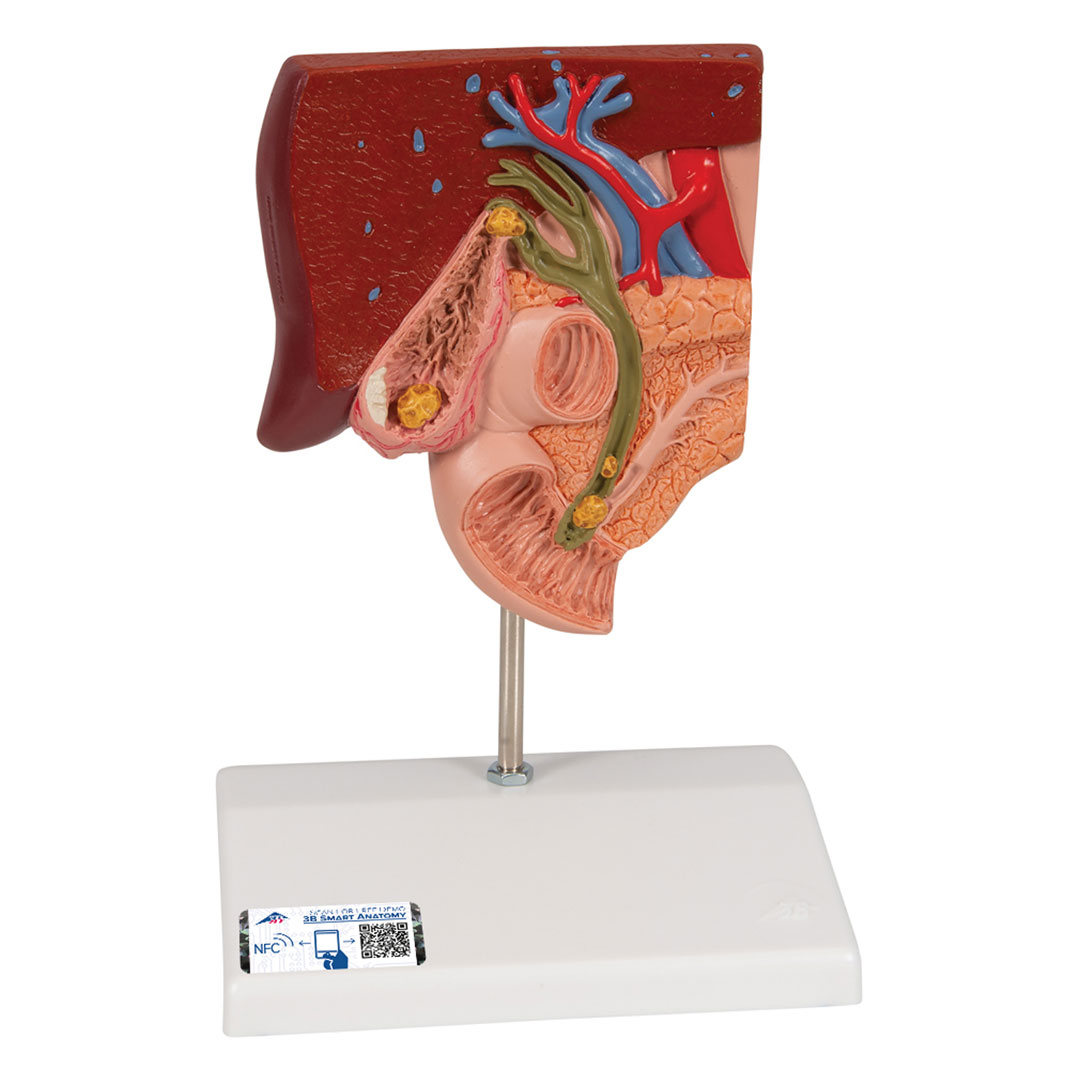 3B SCIENTIFIC Gallensteine, Modell (K26)
