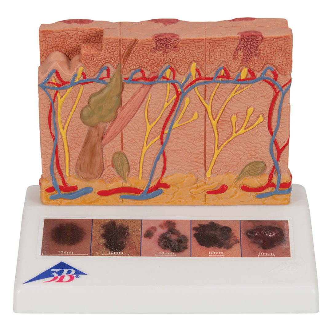 3B SCIENTIFIC Hautkrebs-Modell (J15)