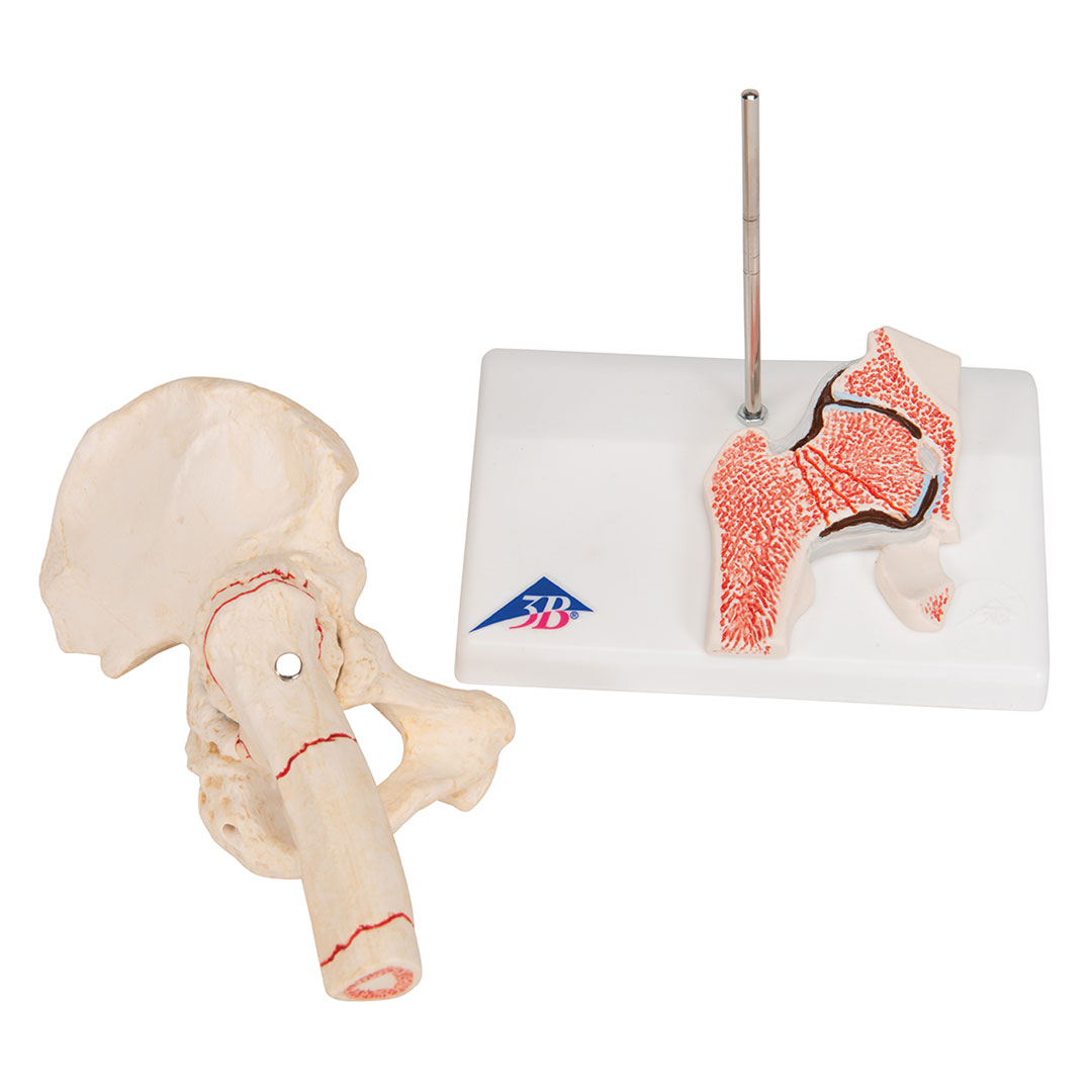 3B SCIENTIFIC Oberschenkelbruch und Hüftgelenkverschleiss (A88)