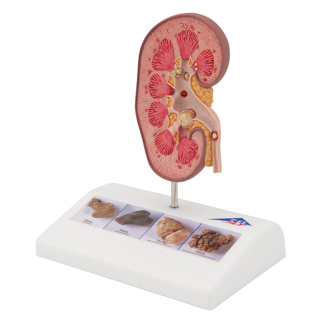 3B SCIENTIFIC Nierensteinmodell (K29)