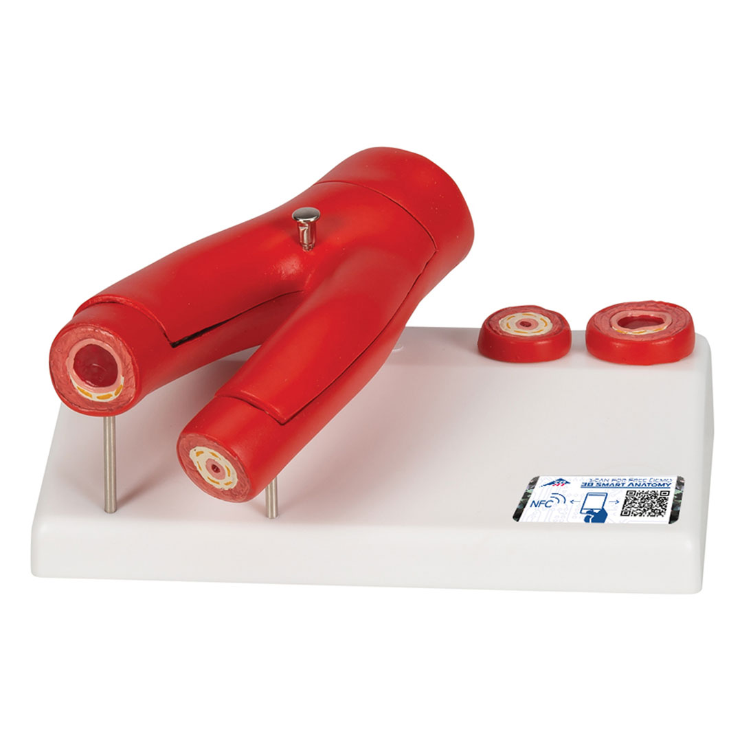 3B SCIENTIFIC Arteriosklerose Modell (G40) mit Querschnitt der Arterie, 2-teilig