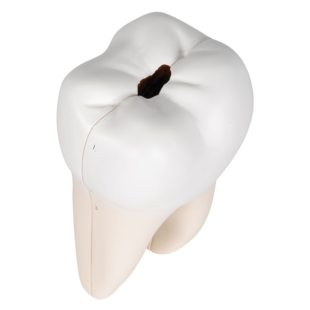 3B SCIENTIFIC Unterer 2-wurzl.Backenzahn m.Karies,2-t. (D10/4)