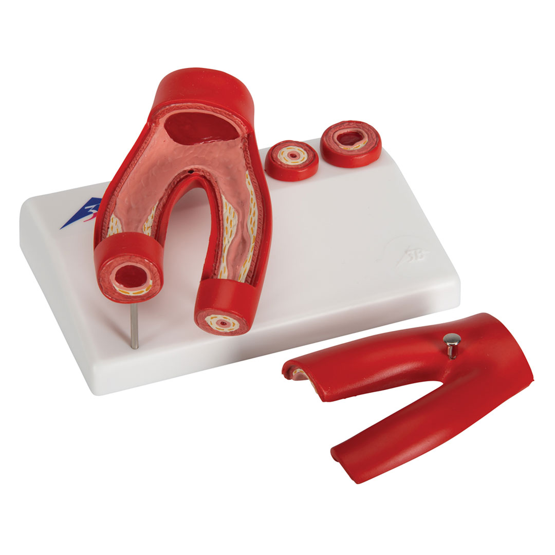 3B SCIENTIFIC Arteriosklerose Modell (G40) mit Querschnitt der Arterie, 2-teilig