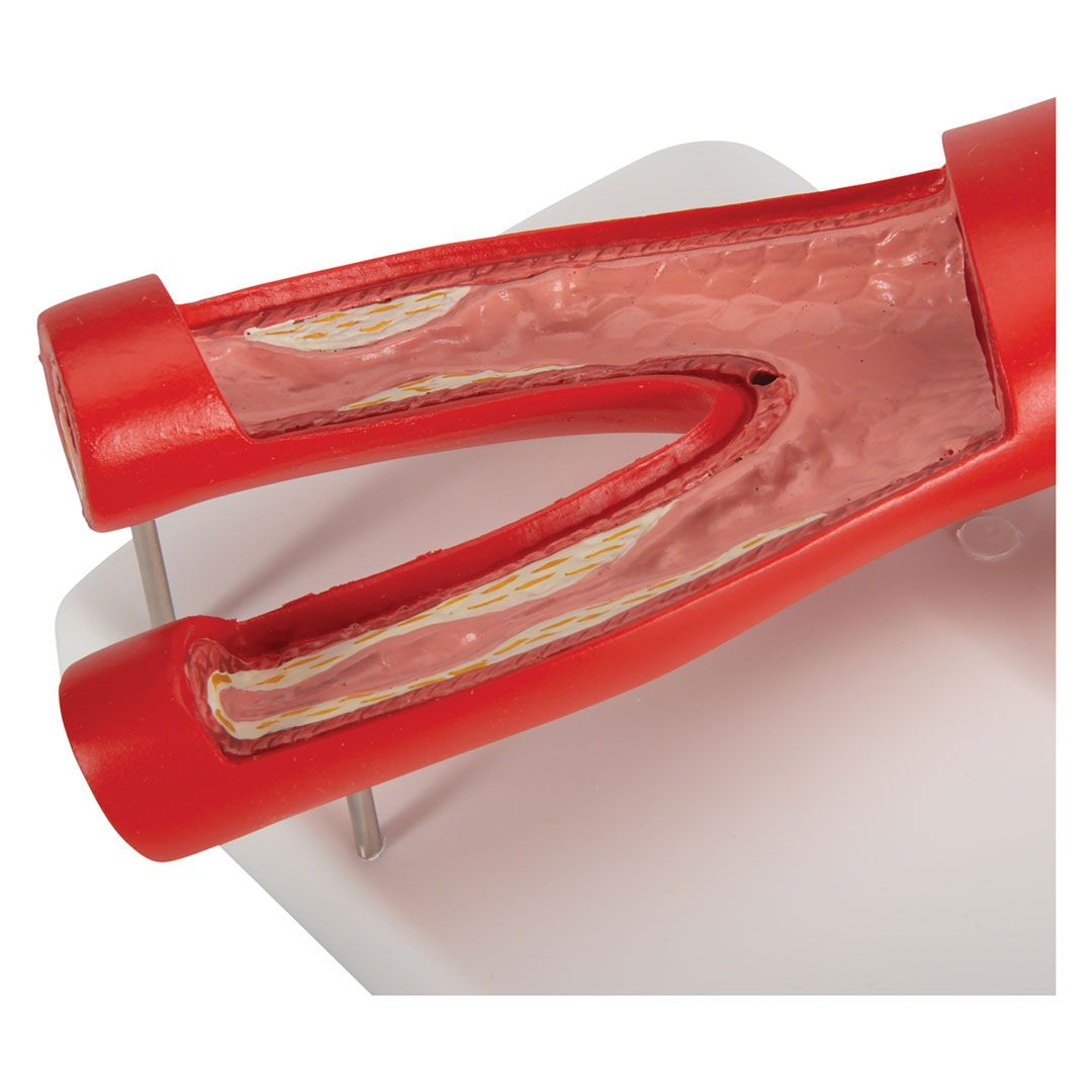 3B SCIENTIFIC Arteriosklerose Modell (G40) mit Querschnitt der Arterie, 2-teilig