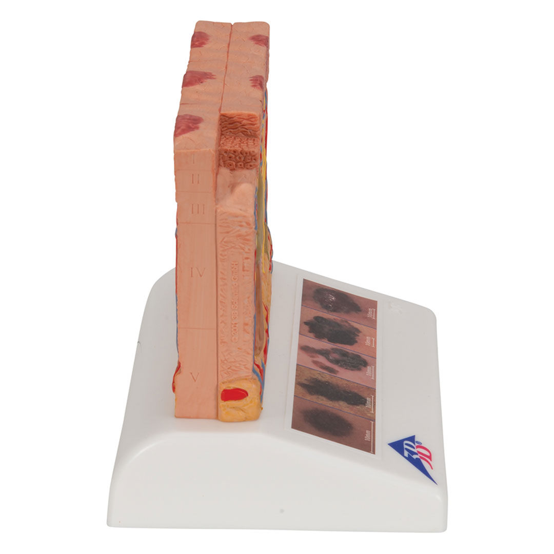 3B SCIENTIFIC Hautkrebs-Modell (J15)