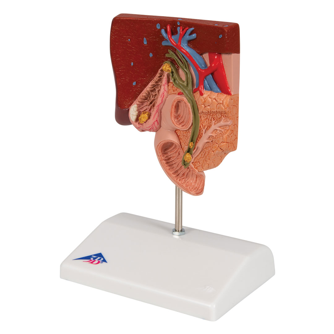 3B SCIENTIFIC Gallensteine, Modell (K26)