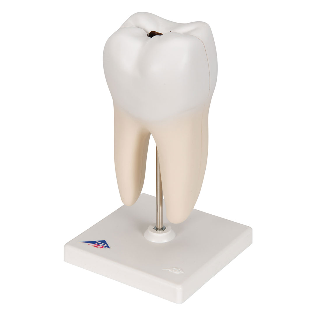 3B SCIENTIFIC Unterer 2-wurzl.Backenzahn m.Karies,2-t. (D10/4)