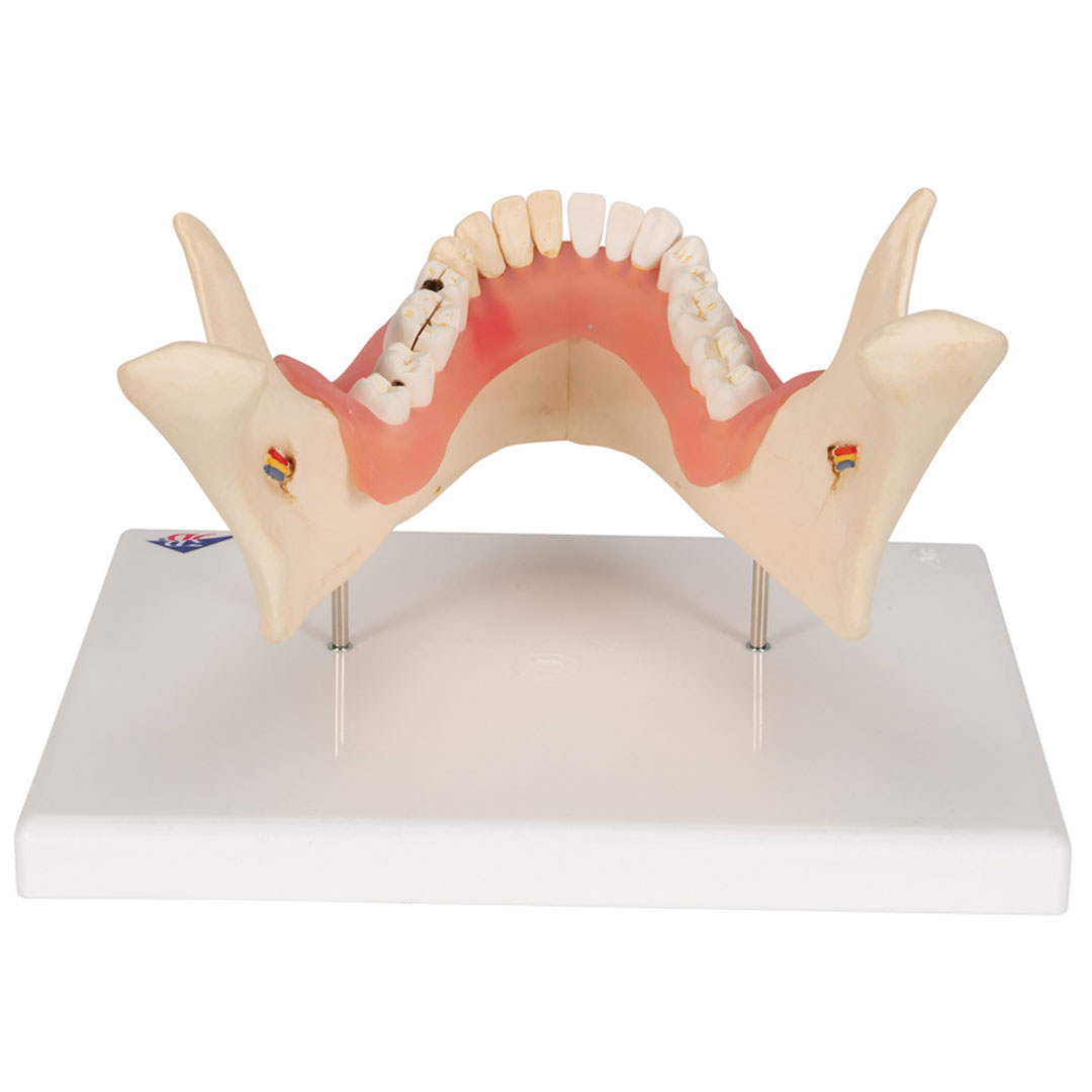 3B SCIENTIFIC Zahnerkrankung Unterkiefermodell 2-fach vergrössert (D26)