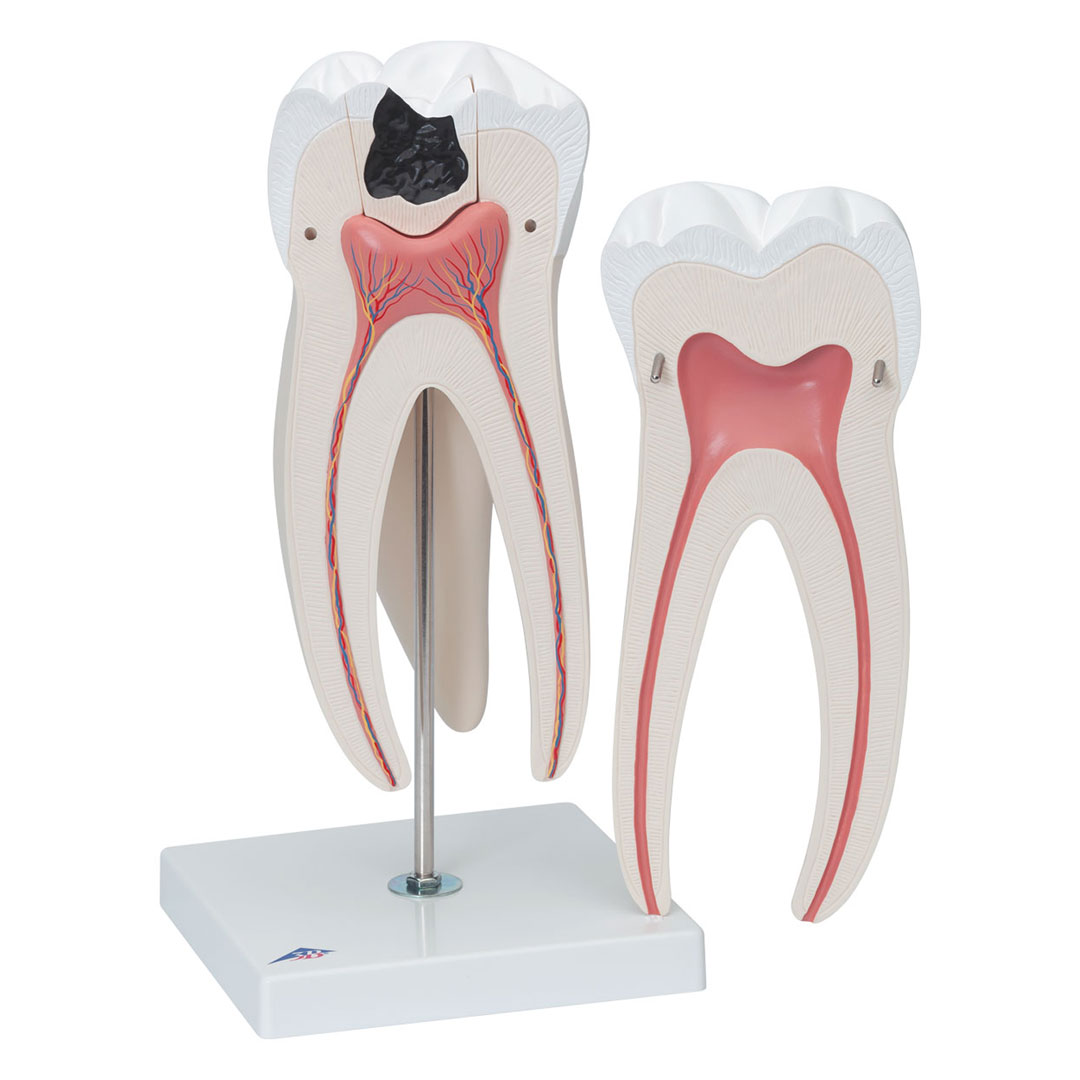 3B SCIENTIFIC Mahlzahn, oben, dreiwurzelig, 5-tlg. (D15)