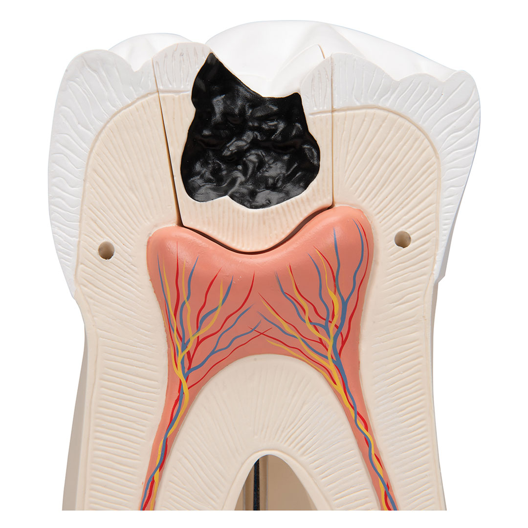 3B SCIENTIFIC Mahlzahn, oben, dreiwurzelig, 5-tlg. (D15)