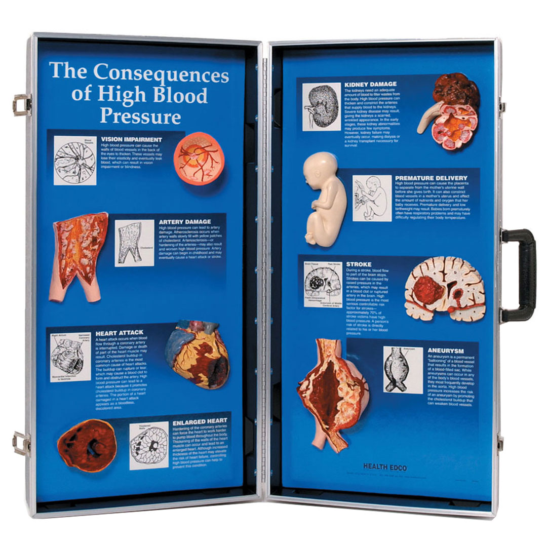 3B SCIENTIFIC Bluthochdruck, 3D-Tafel (W43081)