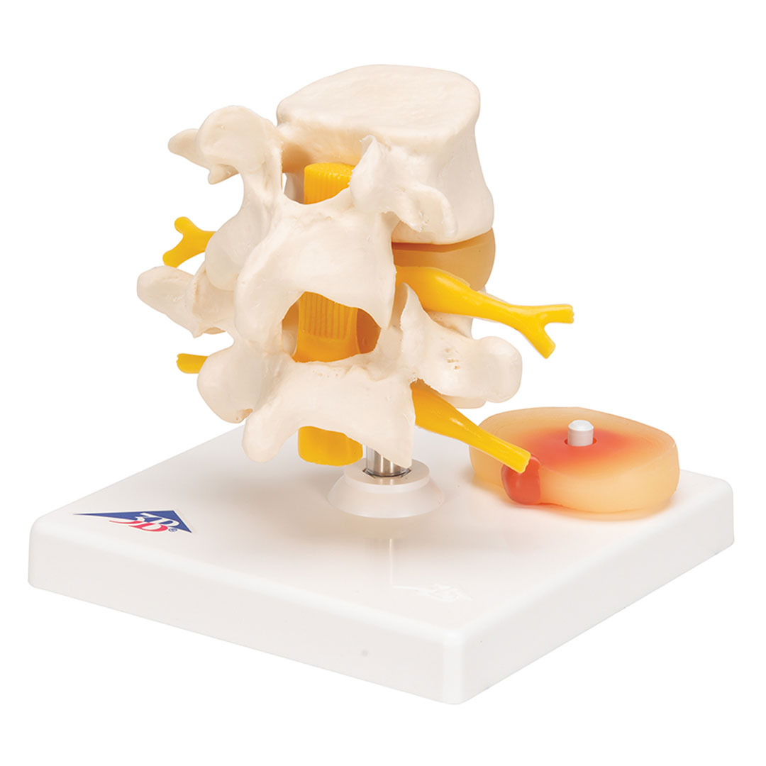3B SCIENTIFIC Lendenwirbelmod. mit Bandscheibenvorfall (A76)