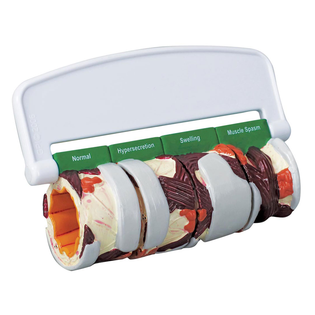 3B SCIENTIFIC Bronchusmodell 4-teilig, (W33362)