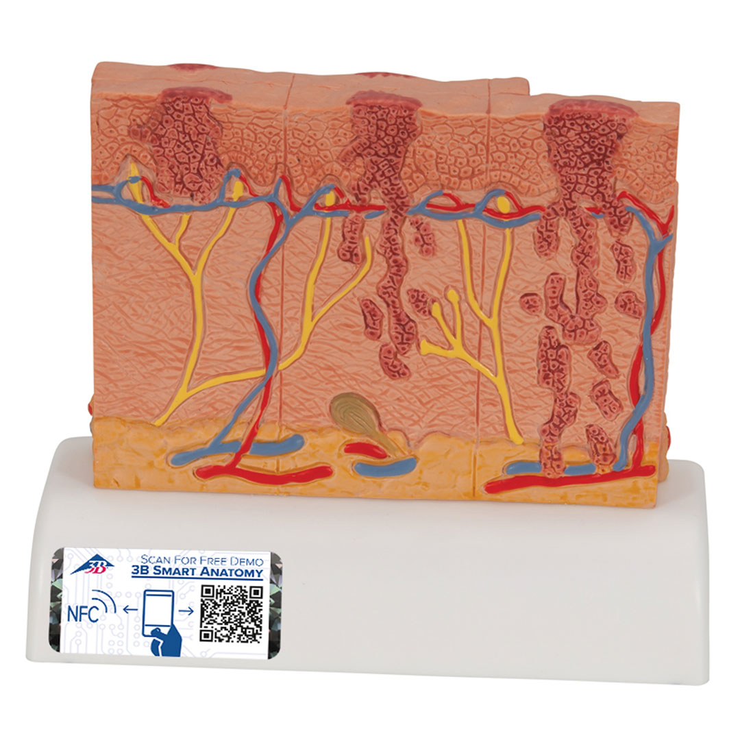 3B SCIENTIFIC Hautkrebs-Modell (J15)