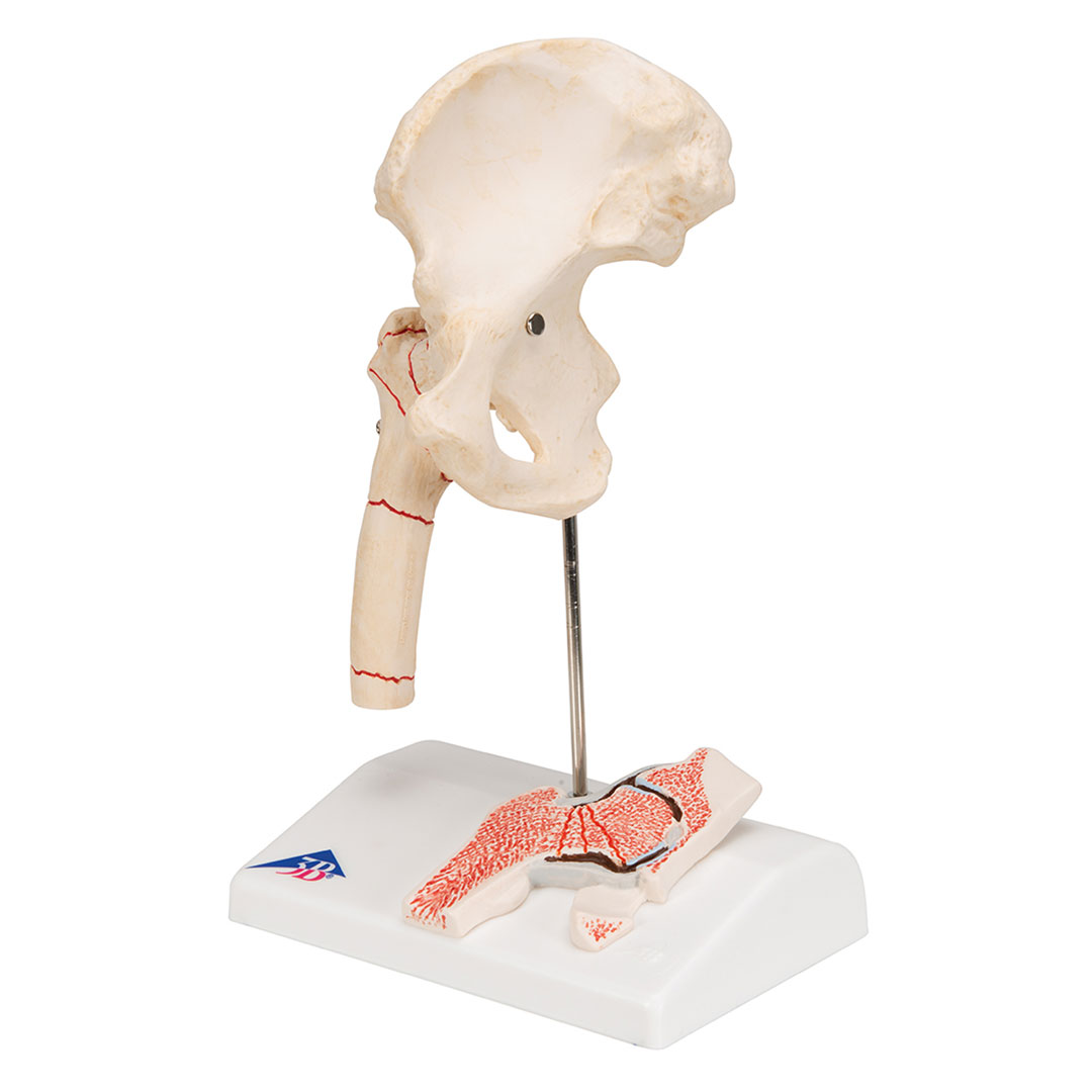 3B SCIENTIFIC Oberschenkelbruch und Hüftgelenkverschleiss (A88)