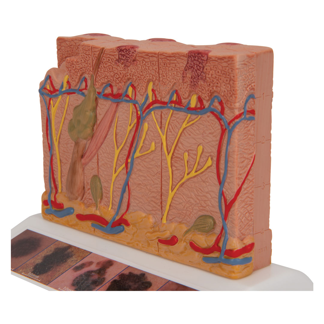 3B SCIENTIFIC Hautkrebs-Modell (J15)