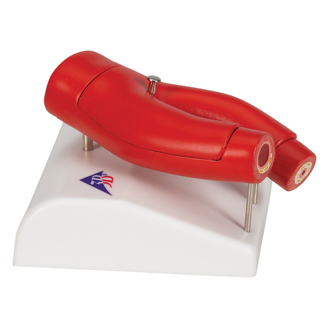 3B SCIENTIFIC Arteriosklerose Modell (G40) mit Querschnitt der Arterie, 2-teilig