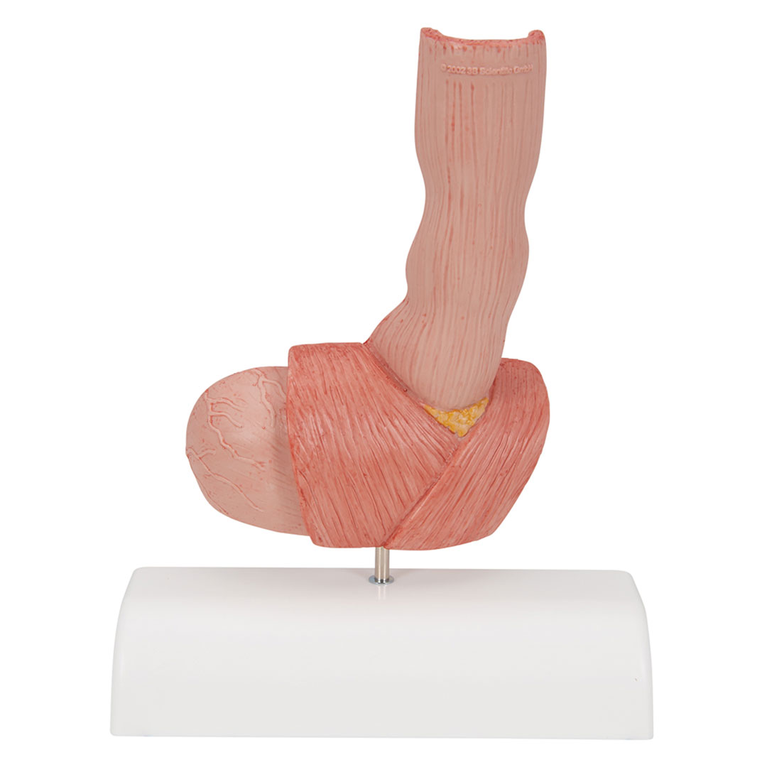 3B SCIENTIFIC Erkrankung der Speiseröhre (K18)