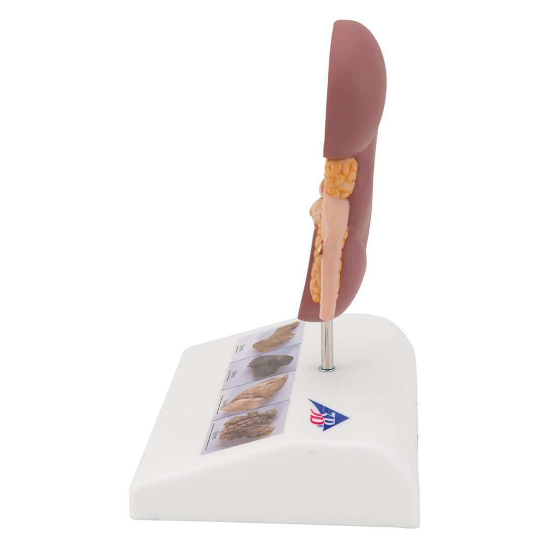 3B SCIENTIFIC Nierensteinmodell (K29)