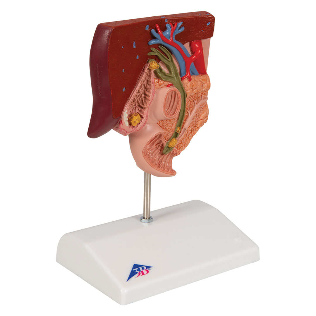 3B SCIENTIFIC Gallensteine, Modell (K26)