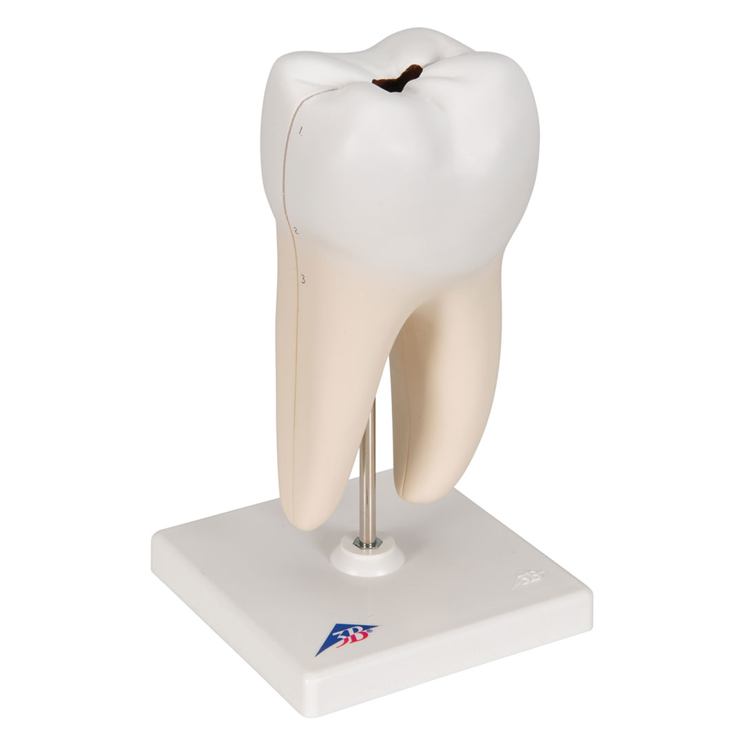 3B SCIENTIFIC Unterer 2-wurzl.Backenzahn m.Karies,2-t. (D10/4)