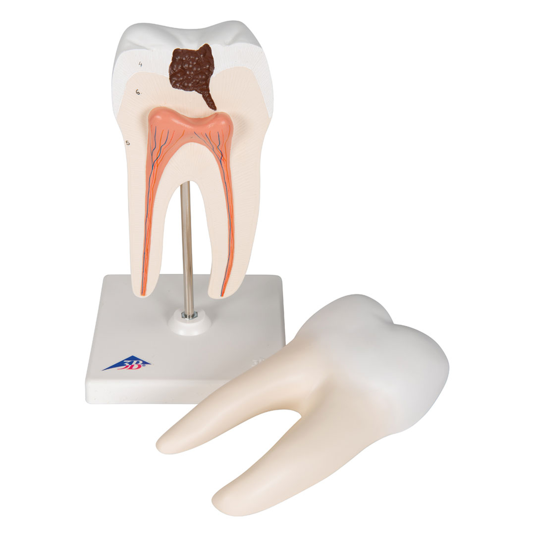 3B SCIENTIFIC Unterer 2-wurzl.Backenzahn m.Karies,2-t. (D10/4)