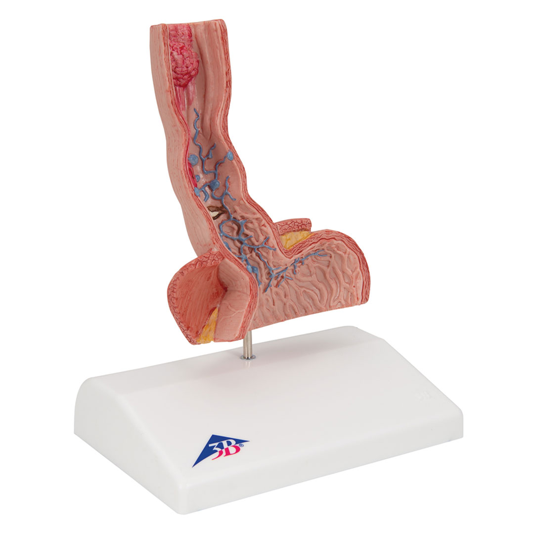 3B SCIENTIFIC Erkrankung der Speiseröhre (K18)