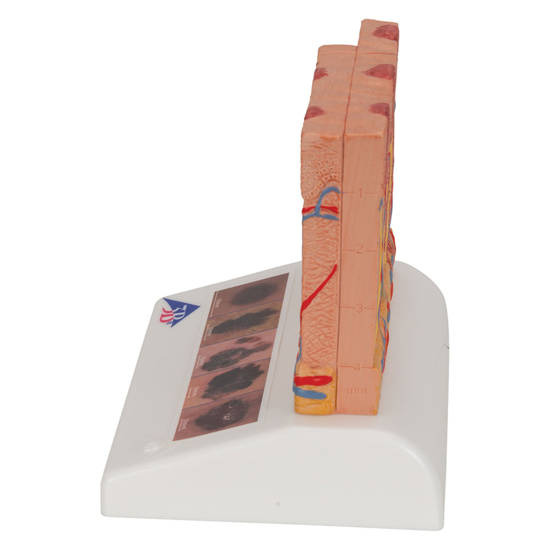 3B SCIENTIFIC Hautkrebs-Modell (J15)