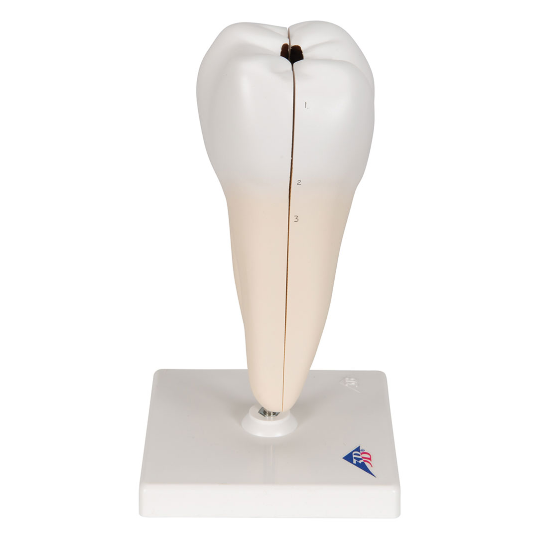 3B SCIENTIFIC Unterer 2-wurzl.Backenzahn m.Karies,2-t. (D10/4)