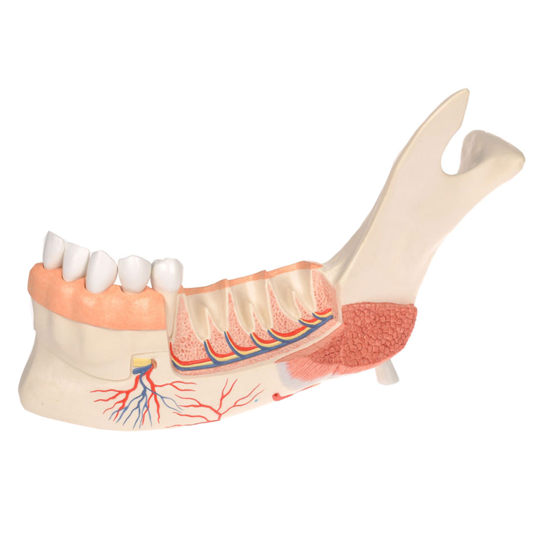 3B SCIENTIFIC Unterkieferhälfte m. 8 kariösen Zähnen, 19-teilig