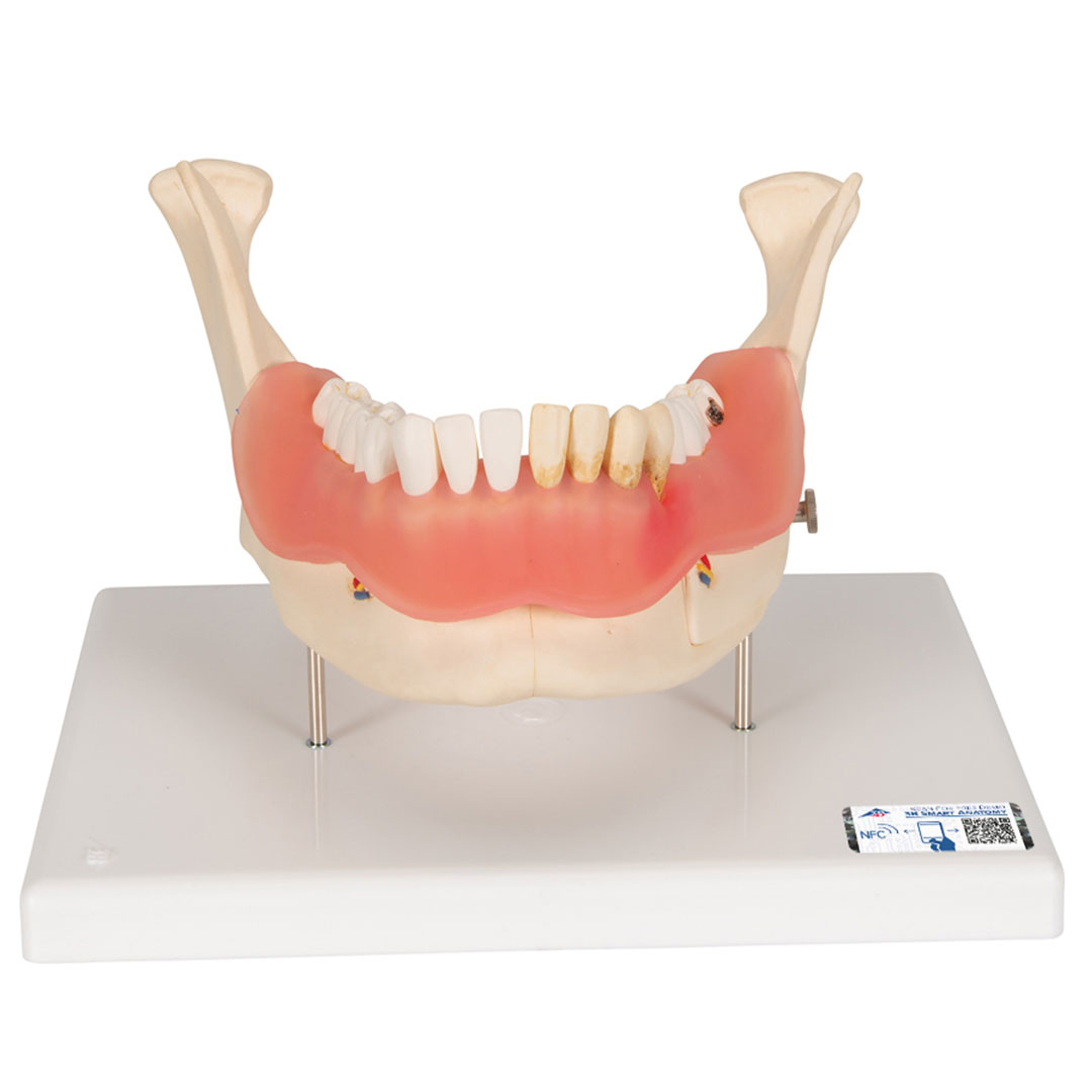 3B SCIENTIFIC Zahnerkrankung Unterkiefermodell 2-fach vergrössert (D26)