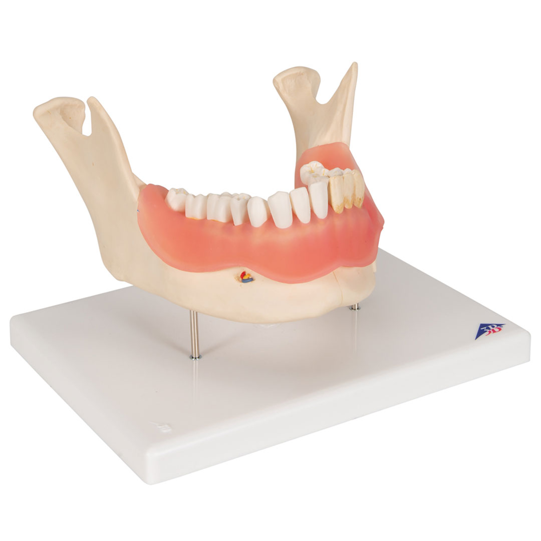 3B SCIENTIFIC Zahnerkrankung Unterkiefermodell 2-fach vergrössert (D26)
